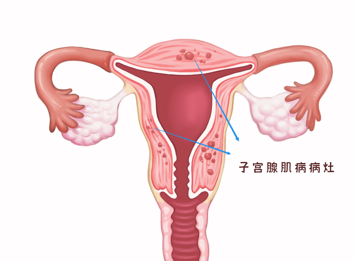 子宫腺肌病对怀孕的影响，你万万想不到！