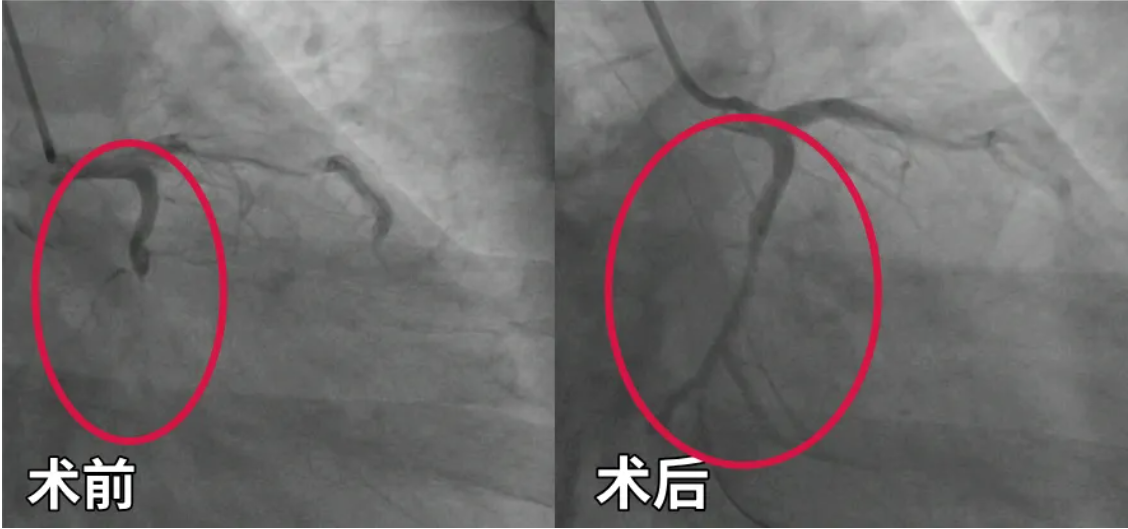 年轻人心梗更致命!遇上胸痛牢记这两个「120」