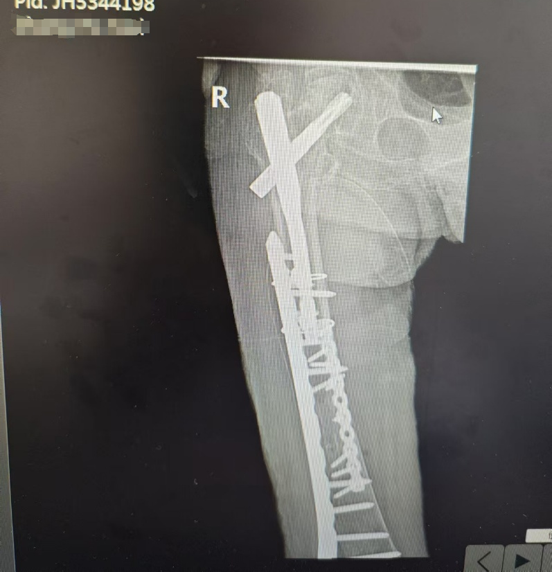 迎难而上!骨科团队成功为百岁外交官行股骨骨折手术