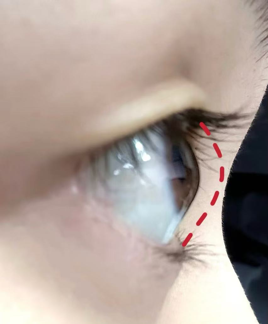 高度近视为什么会眼球突出?武汉普瑞眼科关念告诉您答案