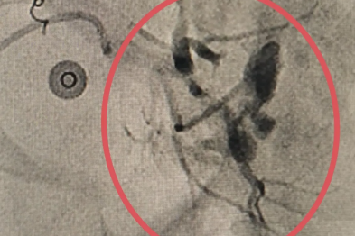 课间玩耍摔倒致脾脏破裂出血，介入栓塞精准封住出血点
