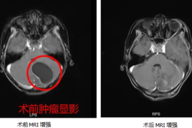 经常头痛，幼童颅内现肿瘤 神外妙手拆弹促康复