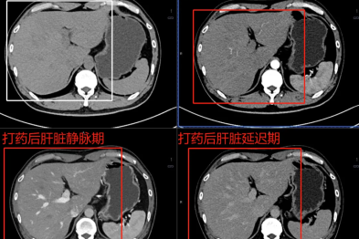 影像检查为什么要建议进一步做增强？