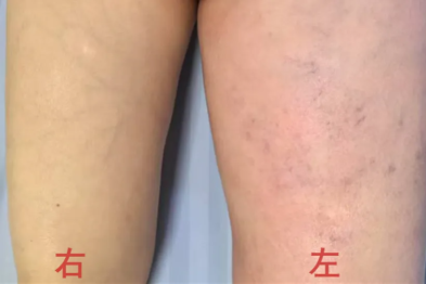 女子肿成「大象腿」，问题竟出在这里