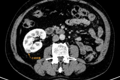 独肾又遇肾癌，医生打响「孤肾保卫战」