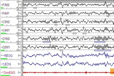 睡不着、睡不好、睡不醒：睡眠障碍悄然流行，你的睡眠还好吗？