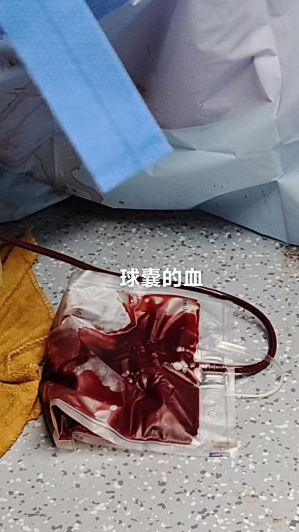 产后突发「致命洪水」 羊水栓塞！5 次全身大换血后，医护修改「生死簿」