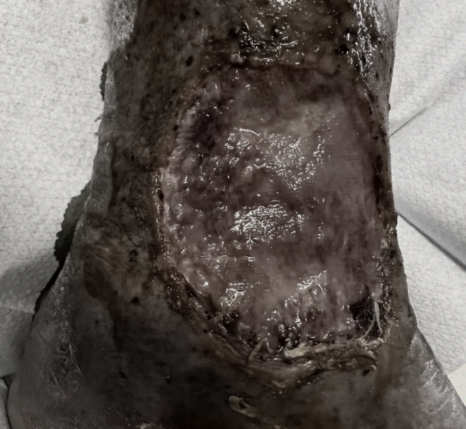 腿上破了个小口子，竟然要截肢！快看看你的小腿有没有这 5 种表现