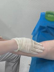 有一种「肿」叫淋巴水肿