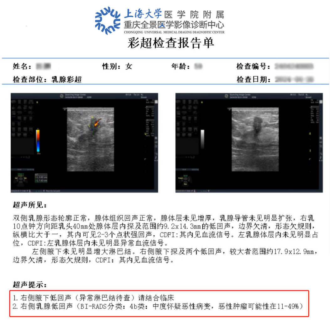 女子无意中摸到乳腺包块，体检竟是乳腺癌