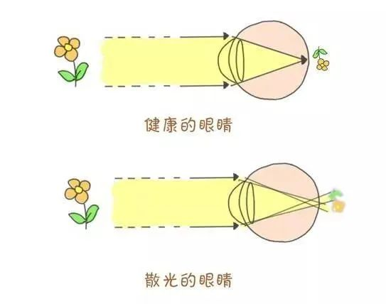 散光和近视有什么区别？武汉普瑞眼科关念告诉你答案