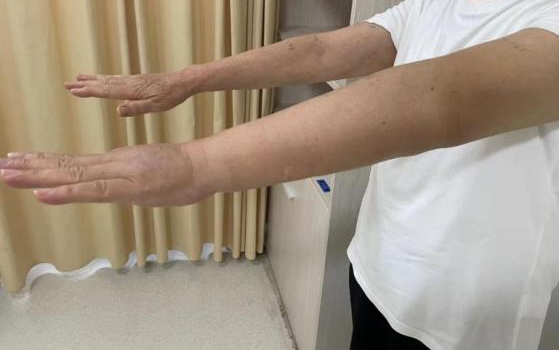 有一种「肿」叫淋巴水肿