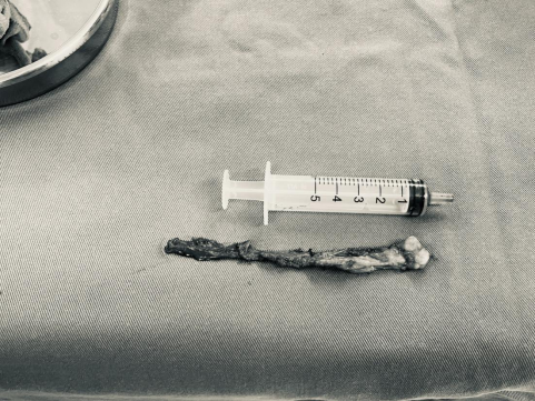 私处长「痘痘」2 月有余,竟是 8 cm 的前庭大腺囊肿!