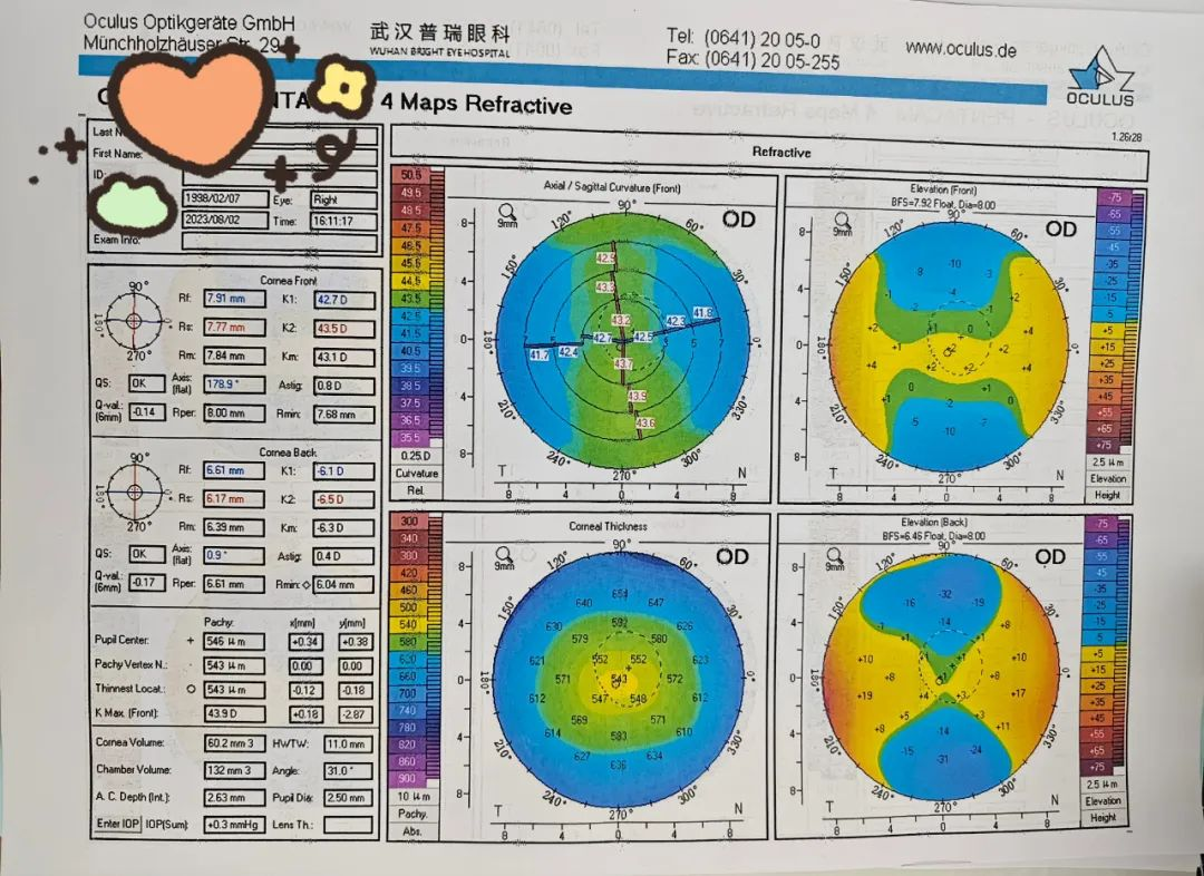 隐形眼镜会影响近视手术效果吗?武汉普瑞眼科关念给你讲解明白