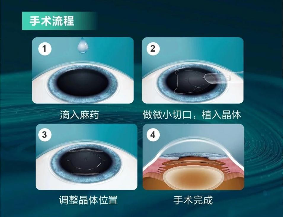 武汉普瑞眼科关念摘镜攻略：精准 ICL 晶体植入近视手术好不好？