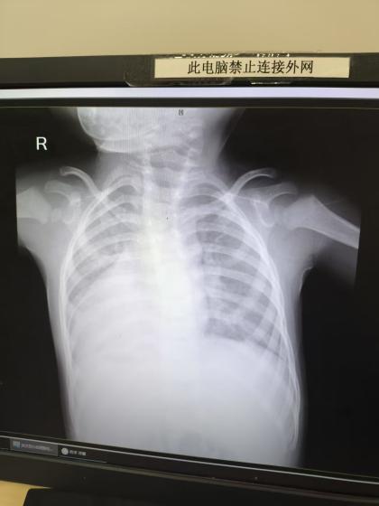 一身器官皆「反骨」:宝贝心脏「溜」右边 河南宝宝赴汉补「心洞」!