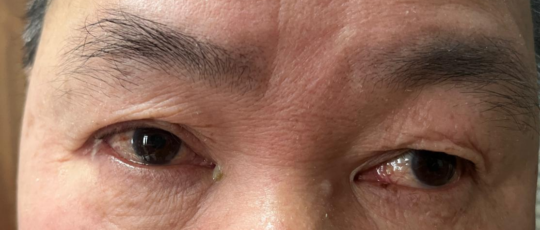 眼药水开封后能用多久？武汉普瑞眼科徐静提醒保质期不是使用期