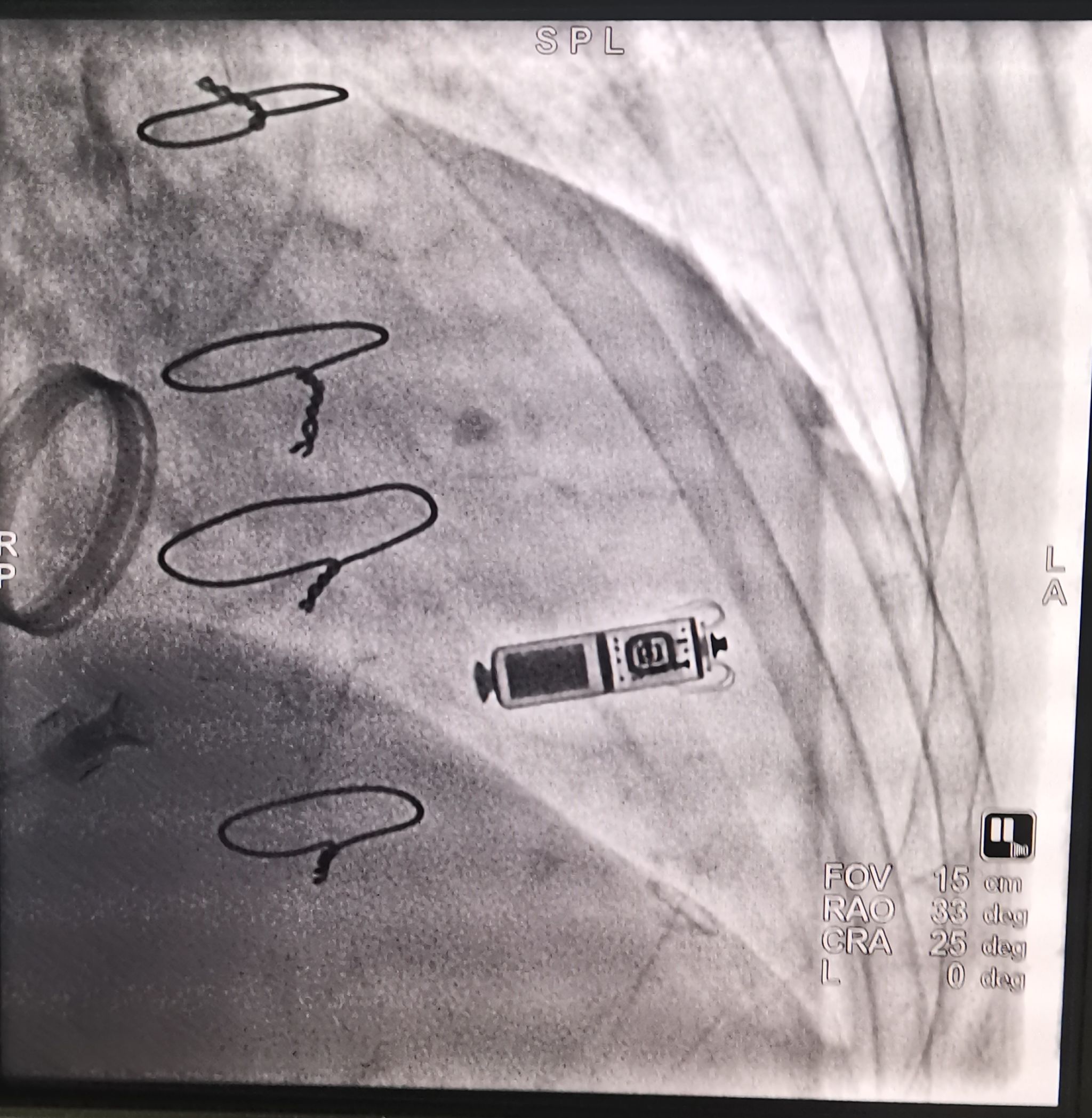 西安交大二附院心内科单日成功为两例高龄患者植入无导线起搏器