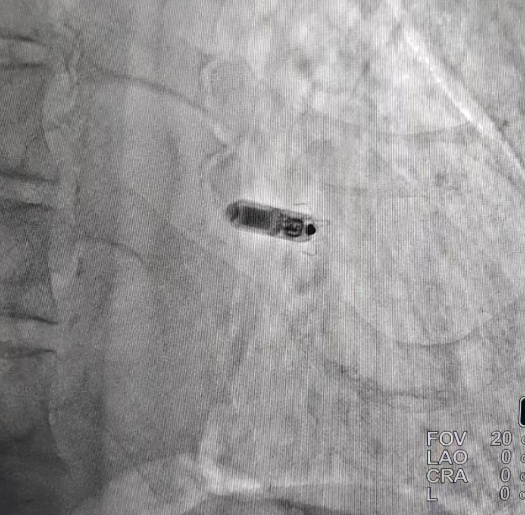 西安交大二附院心内科单日成功为两例高龄患者植入无导线起搏器