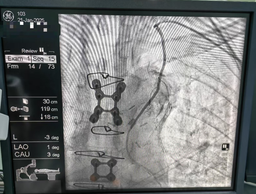 华润武钢总医院心血管内科医生赴瑞州医院完成首例冠状动脉桥血管造影术