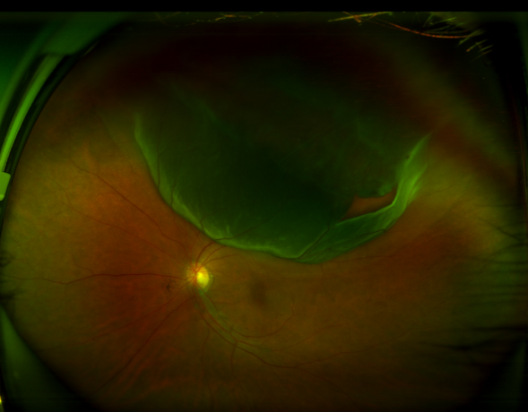 突发孔源性视网膜脱落，重庆爱尔眼科医院紧急手术护其光明！