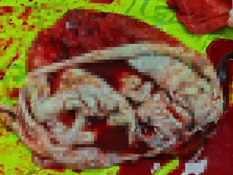 四川蓝生脑科医院综合外科团队成功切除直径 20 厘米、重 10 斤的巨大腹膜后肿瘤!