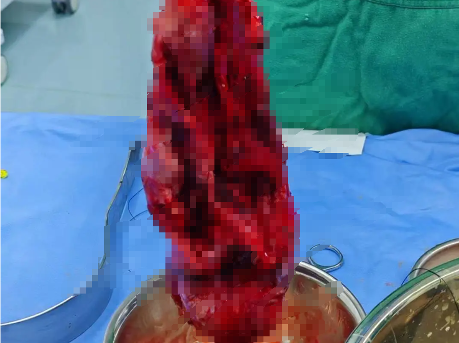 四川蓝生脑科医院综合外科团队成功切除直径 20 厘米、重 10 斤的巨大腹膜后肿瘤!