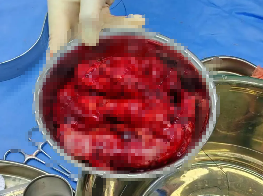 四川蓝生脑科医院综合外科团队成功切除直径 20 厘米、重 10 斤的巨大腹膜后肿瘤!