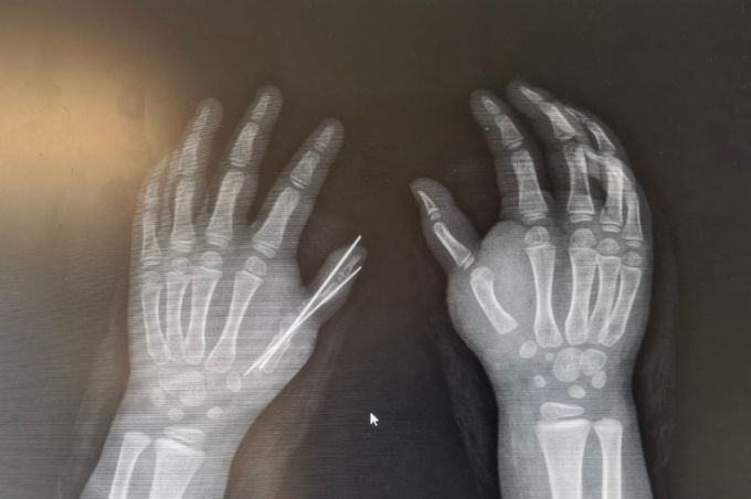 骨科专家挑战高难度手术，助力四岁女童畸形双手重焕生机