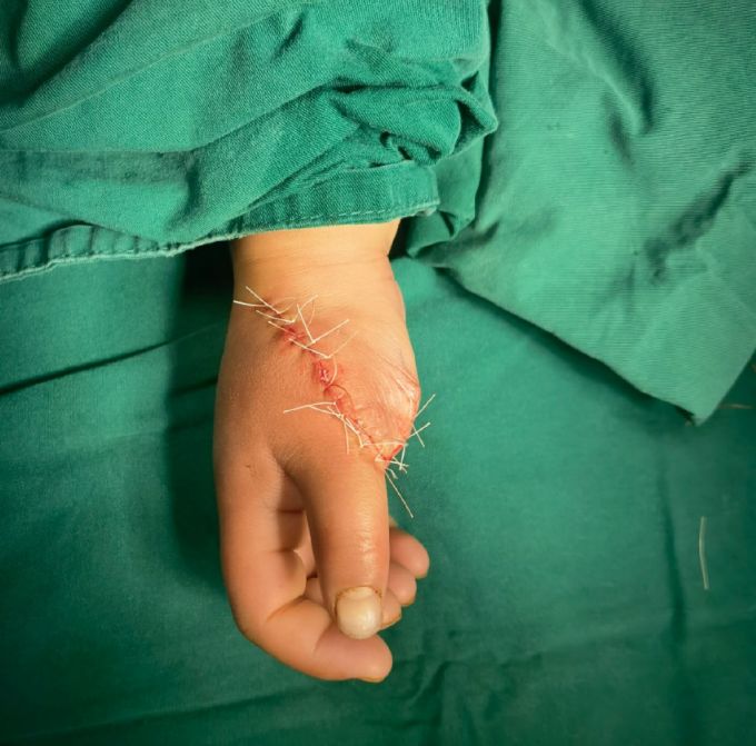 骨科专家挑战高难度手术，助力四岁女童畸形双手重焕生机