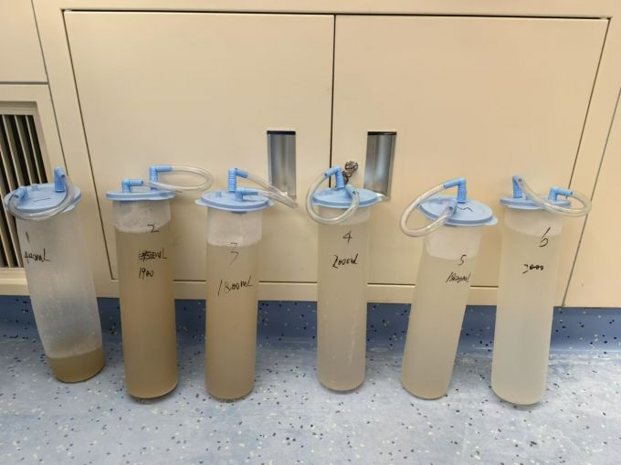 3 小时 11 分钟挑战极限！成都京东方医院成功为高危患者「清洗」肺脏