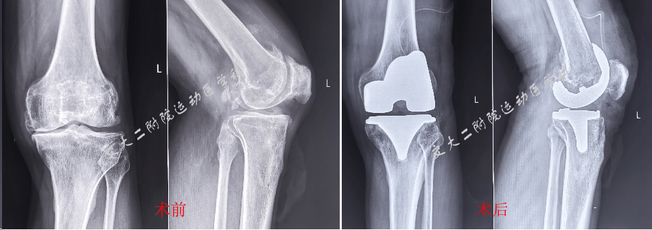 彰显大爱！交大二附院运动医学科为合并 HIV 患者开启手术希望之门