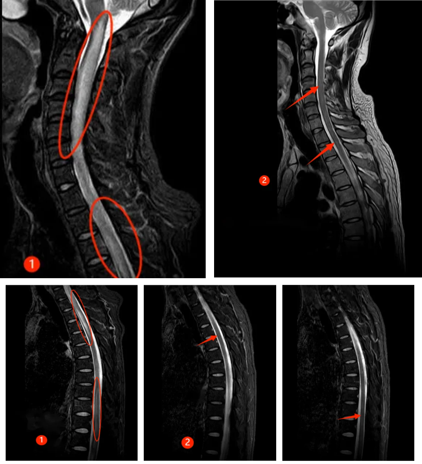 MOGAD,这是什么病?