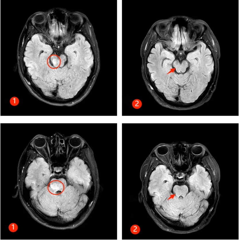 MOGAD,这是什么病?