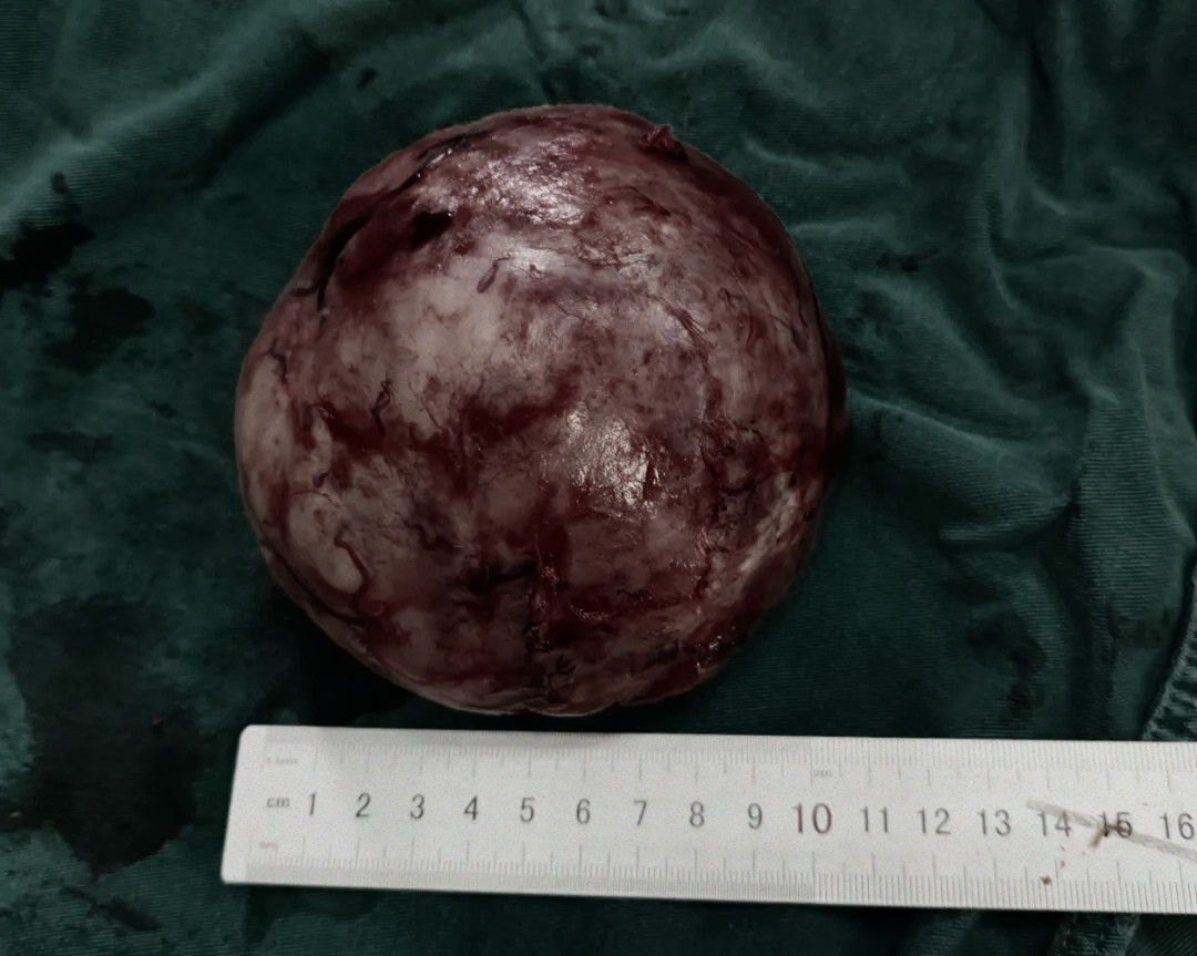 乳房一大一小竟是肿瘤在作祟