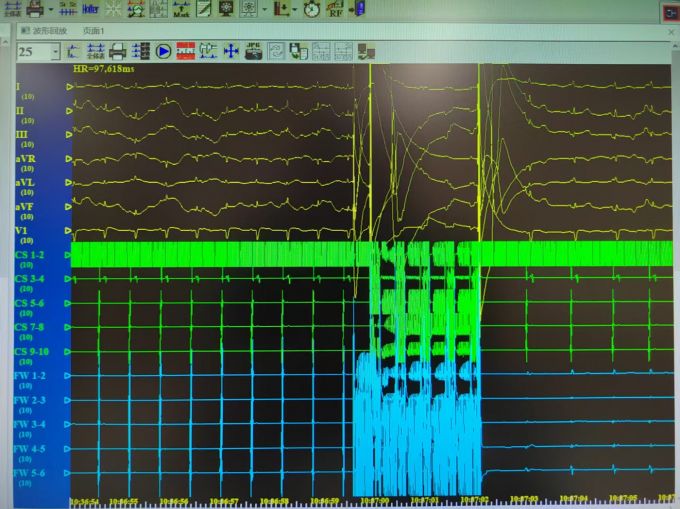 精准治疗！成都京东方医院成功应用无创新技术对抗房颤