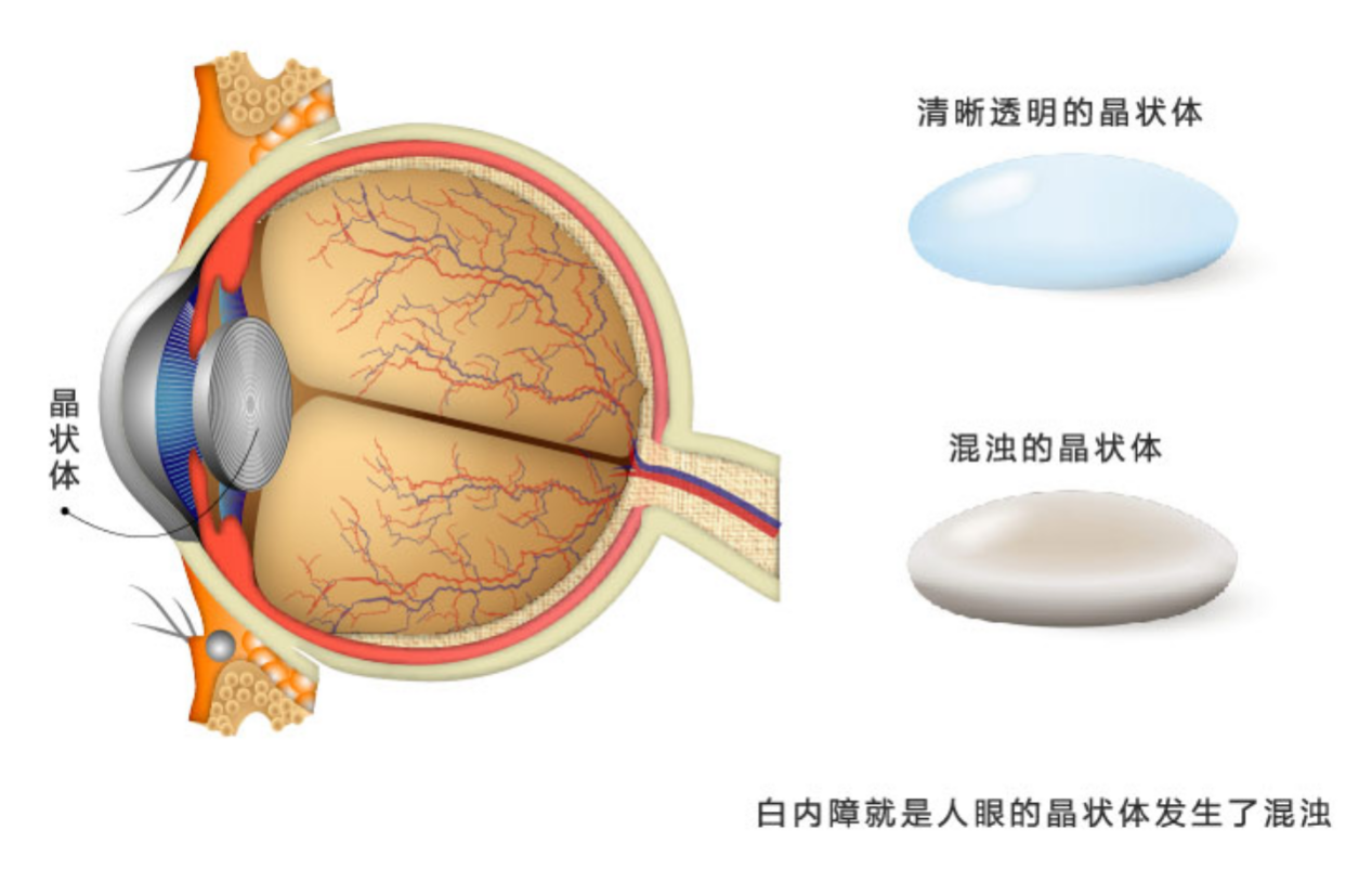 老年人什么时候做白内障手术合适?武汉普瑞眼科程旭康科普请收好