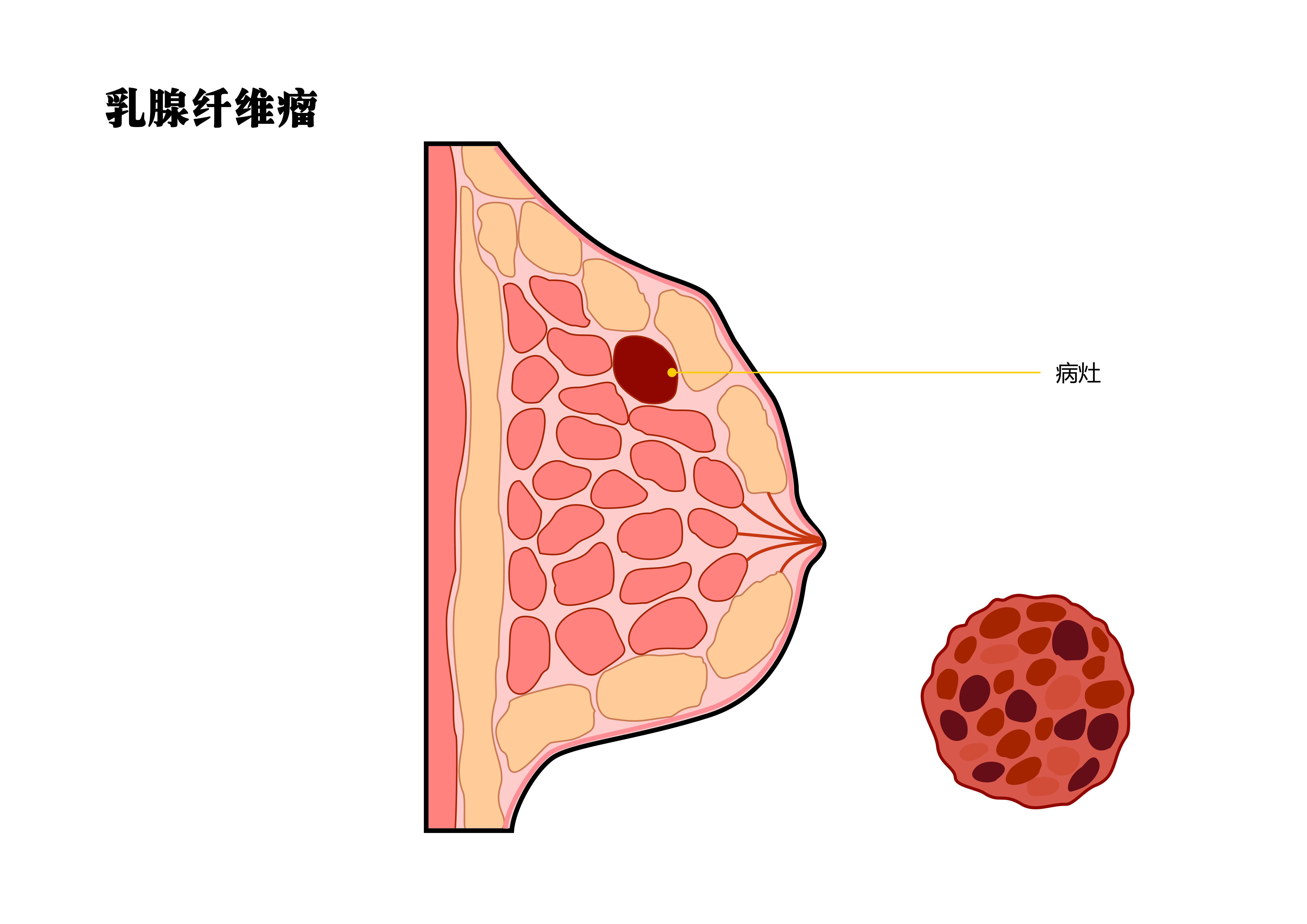 一文说清乳腺纤维瘤