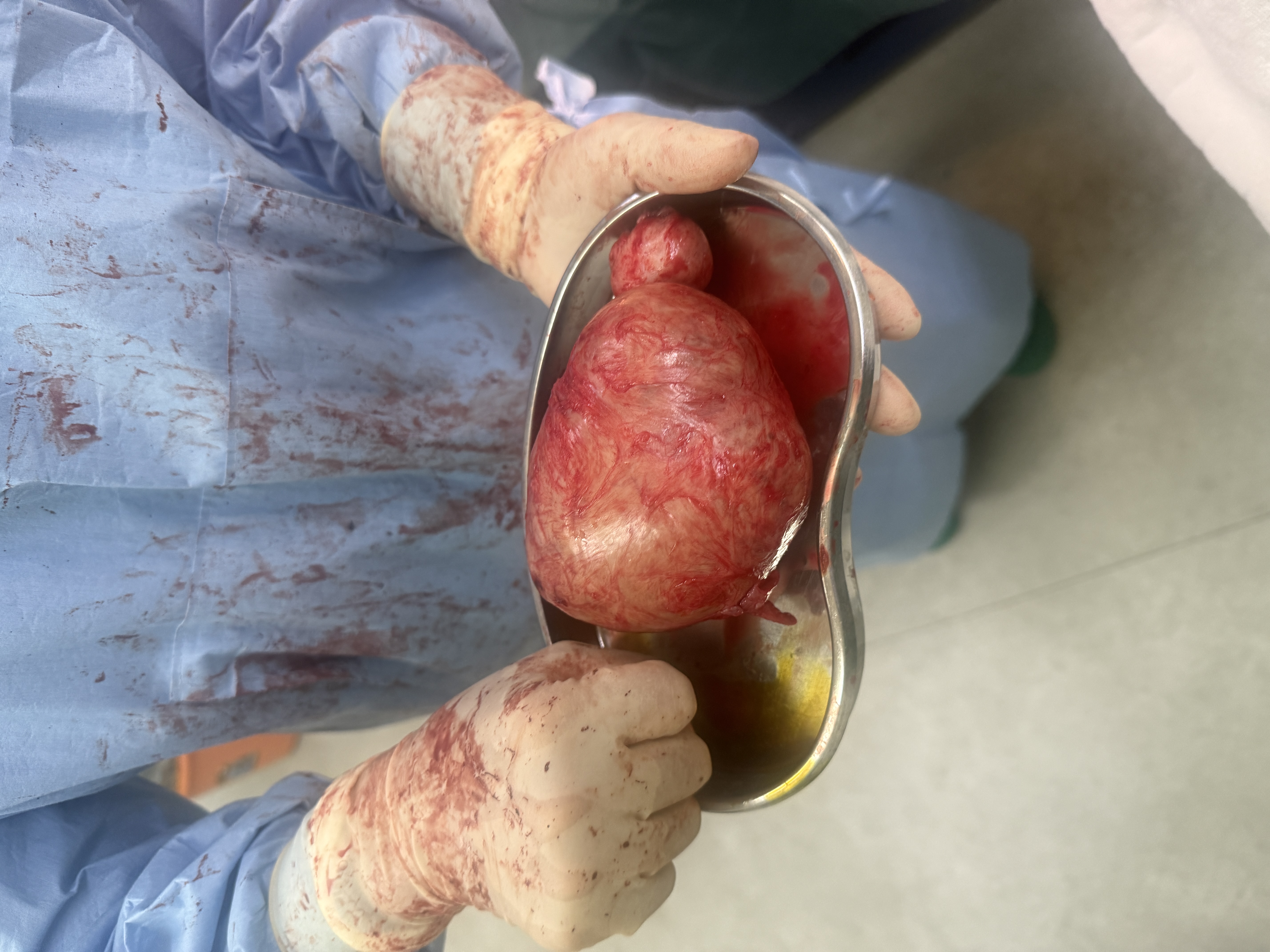 明德成功完成剖宫产同时巨大肌瘤剔除术,用精湛医术和人文关怀守护新生