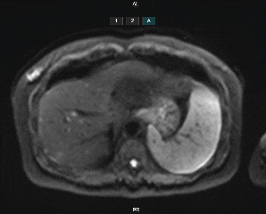 PET/CT 诊断结肠癌肝转移