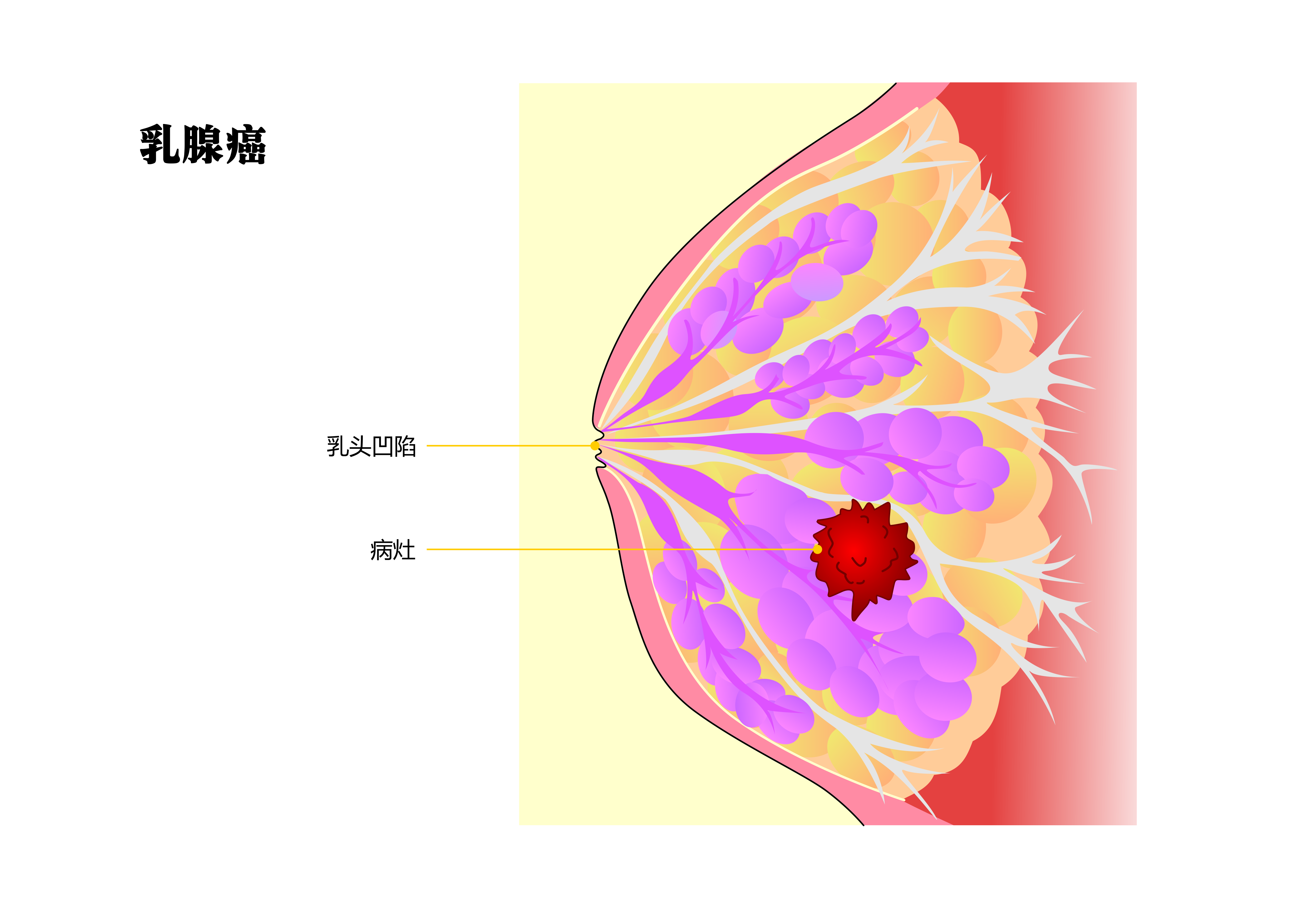 胸部发出这些 「警报」，可能是乳腺癌