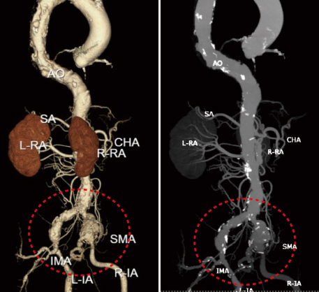 七旬老人「跨国」求医 武汉专家微创「拆弹」