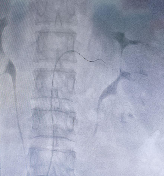 男子吃 5 种降压药血压仍「失控」 肾动脉上一根导管解难题