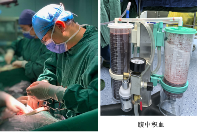 惊险！南昌大学二附院多学科联动救治肝癌破裂出血并失血性休克患者