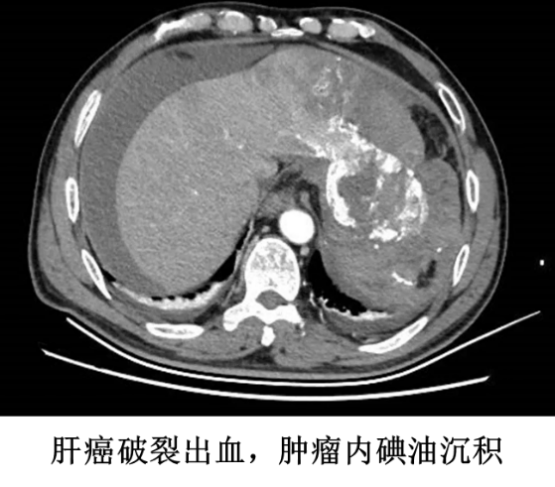 惊险！南昌大学二附院多学科联动救治肝癌破裂出血并失血性休克患者