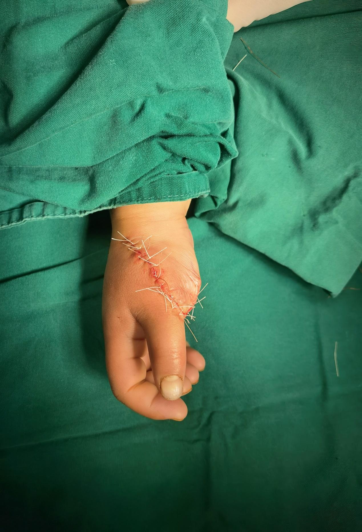 心手双愈！四岁女童在成都京东方医院破茧重生