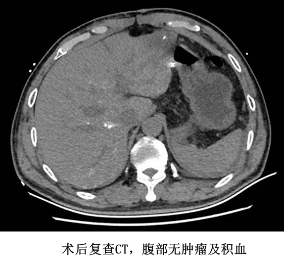 惊险！南昌大学二附院多学科联动救治肝癌破裂出血并失血性休克患者