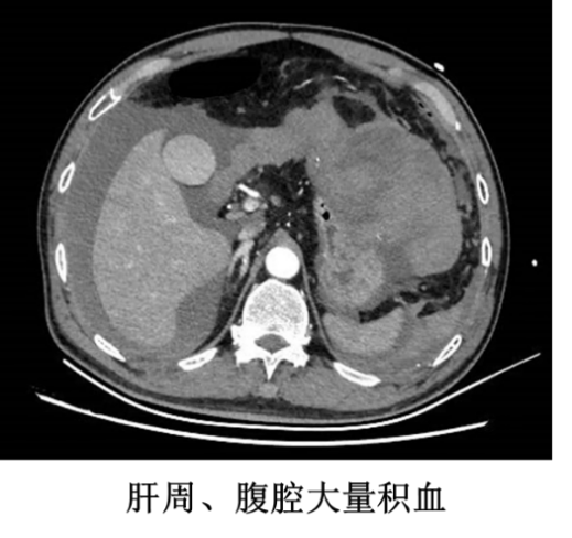 惊险！南昌大学二附院多学科联动救治肝癌破裂出血并失血性休克患者