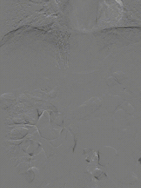 腿肿得像馒头长达 30 年，竟是肚里血管堵了