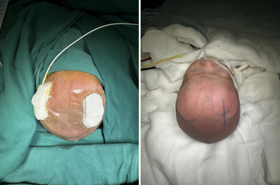 出生仅 1.4 kg，「巴掌宝宝」脑积水、颅内感染……